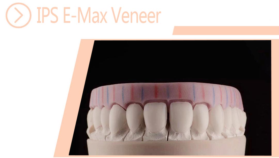 IPS E-Max Veneer