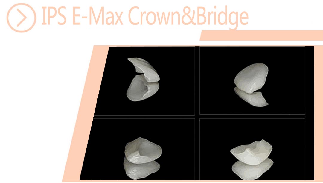 IPS E-Max Crown&Bridge