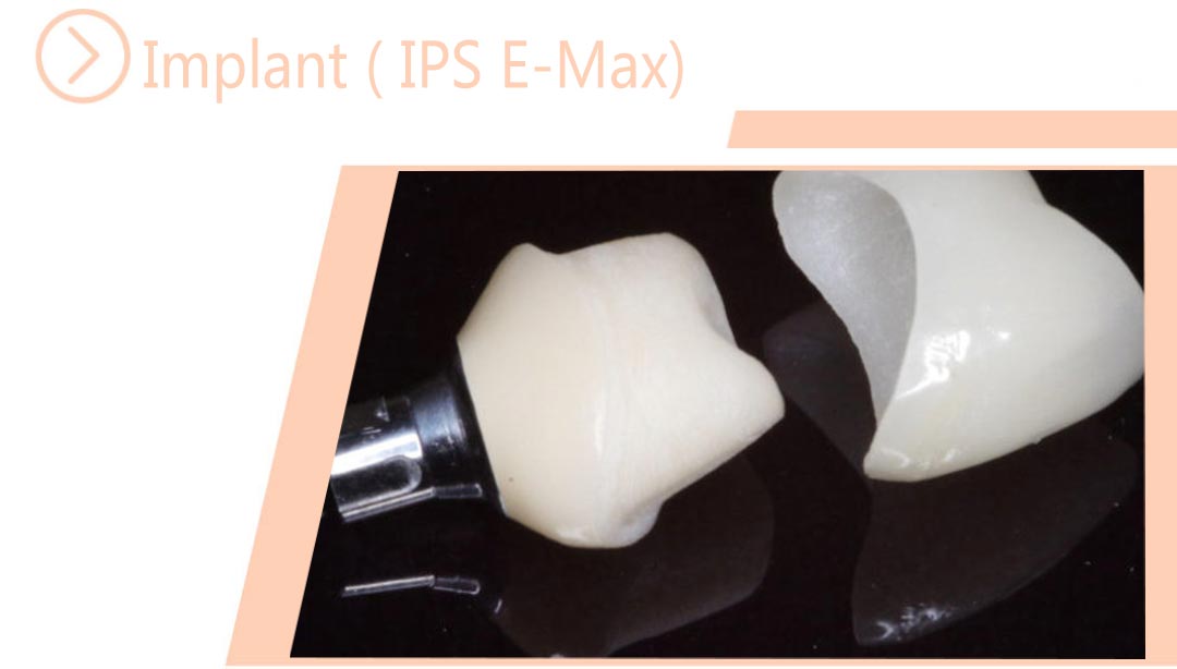 Implant ( IPS E-Max)