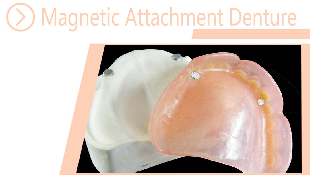 Magnetic Attachment Denture