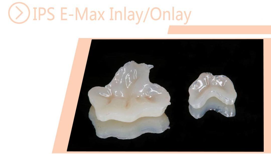 IPS E-Max Inlay/Onlay
