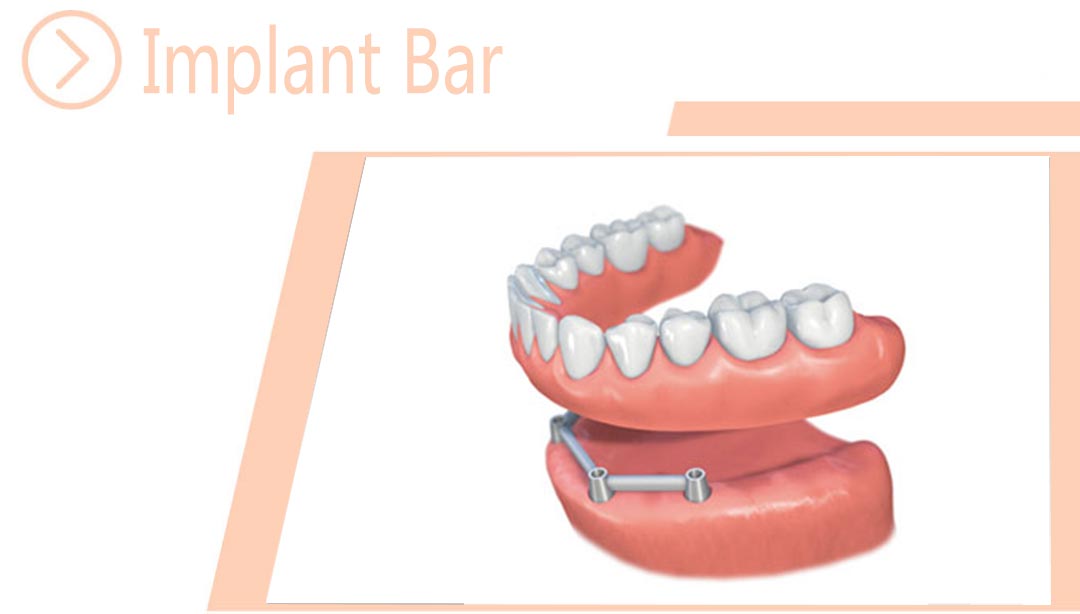Implant Bar