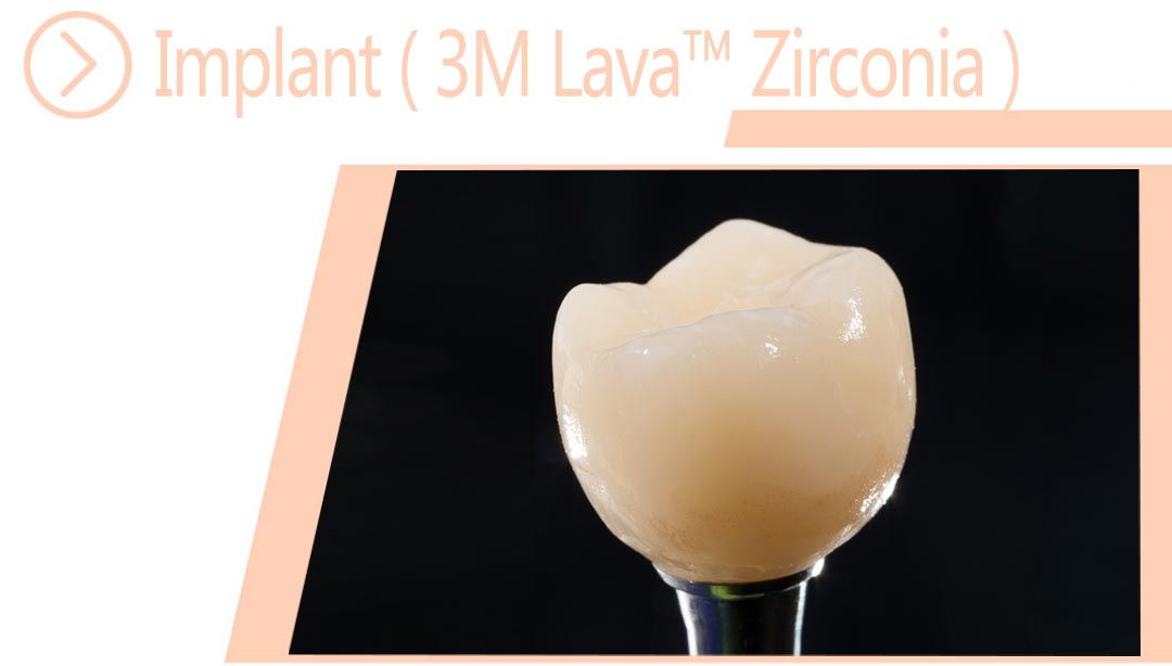 Implant ( 3M Lava™ Zirconia )