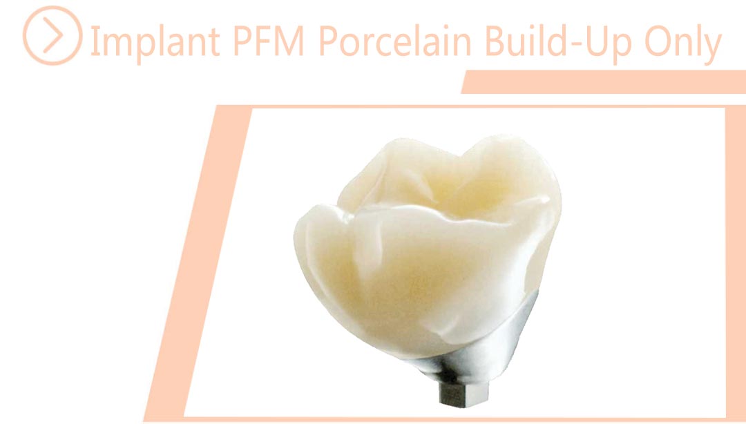 Implant PFM Porcelain Build-Up Only