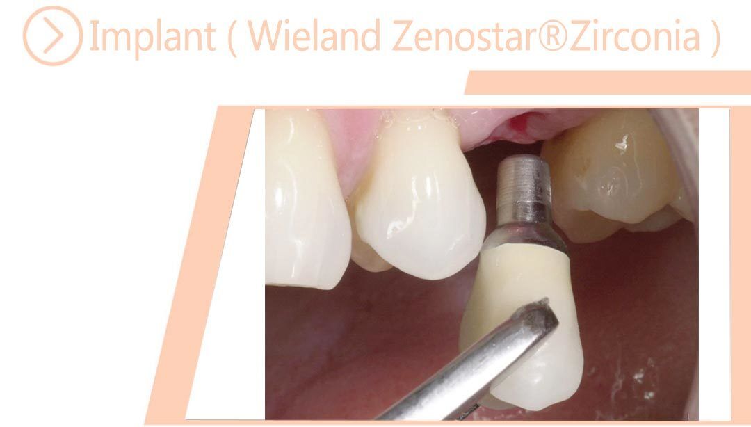 Implant ( Wieland Zenostar® Zirconia )