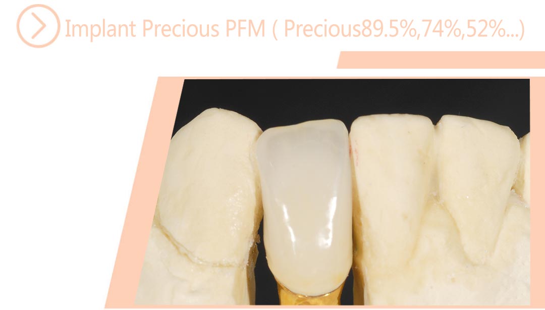 Implant Precious PFM ( Precious89.5%,74%,52%...)