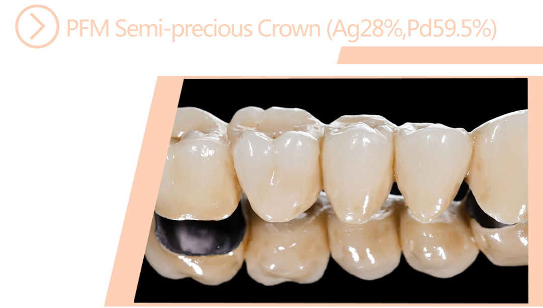 PFM Semi-precious Crown (Ag28%,Pd59.5%)