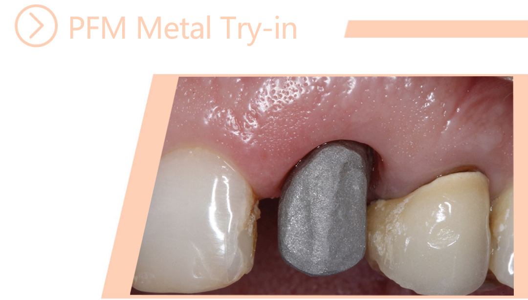 PFM Metal Try-in