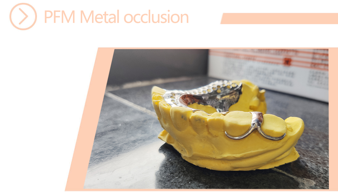 PFM Metal occlusion