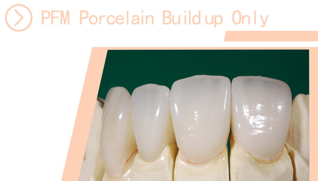 PFM Porcelain Build up Only