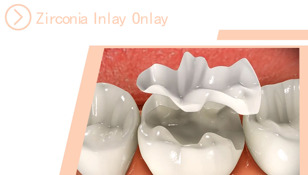 Zirconia Inlay/Onlay