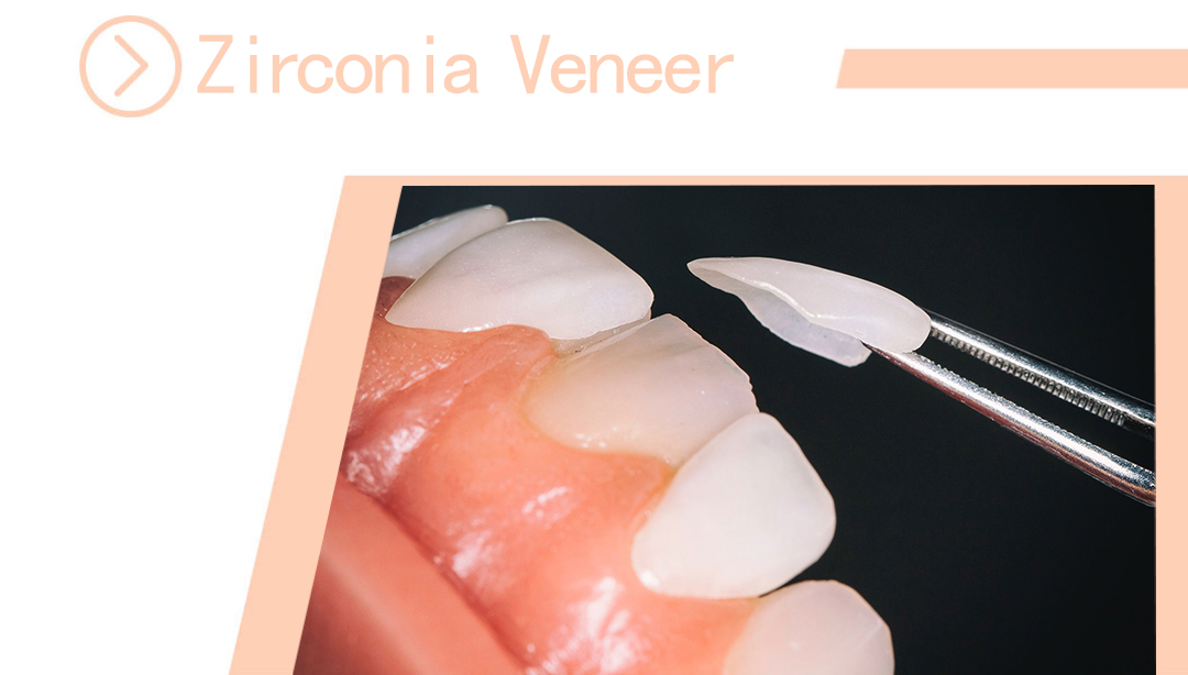 Zirconia Veneer