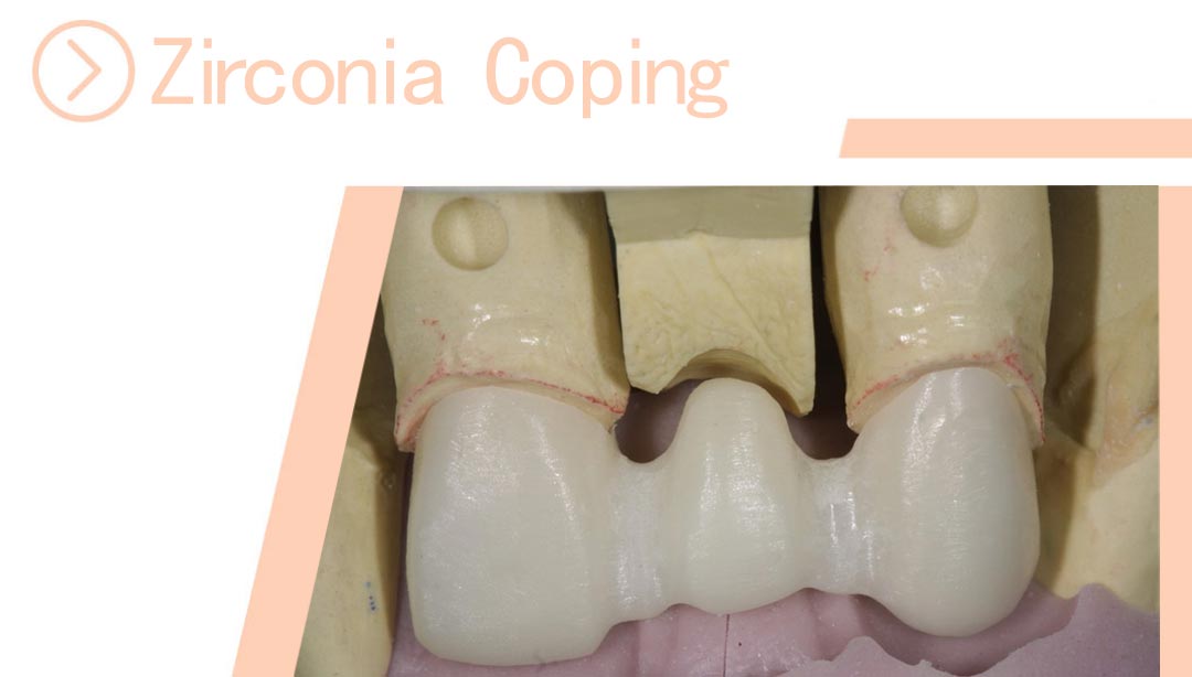 Zirconia Coping