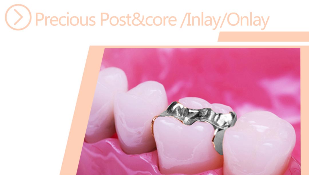 Precious Post&Core /Inlay /Onlay