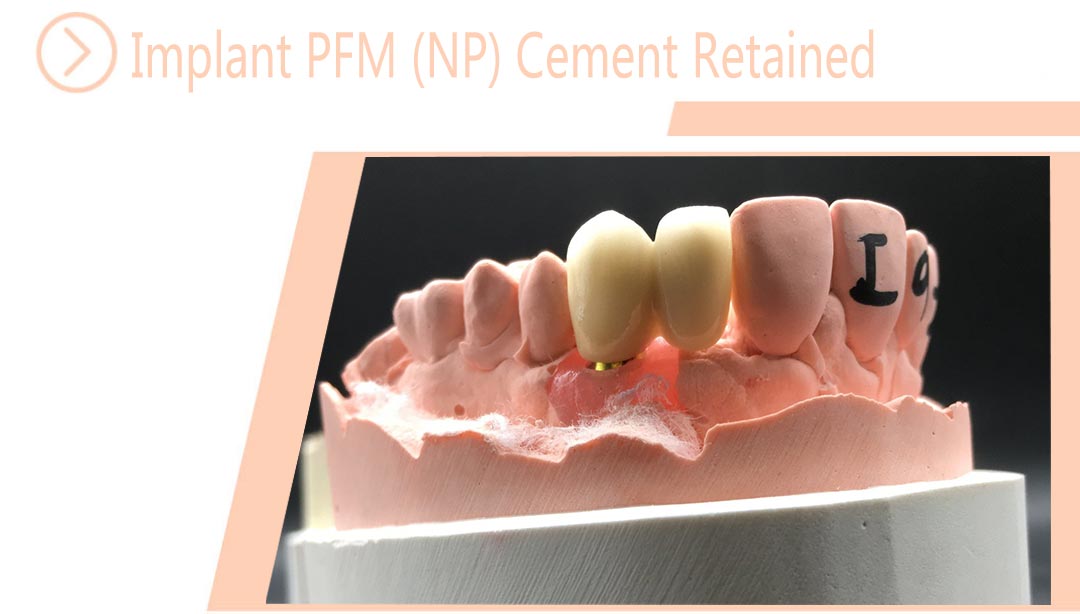 Implant PFM (NP) Cement Retained