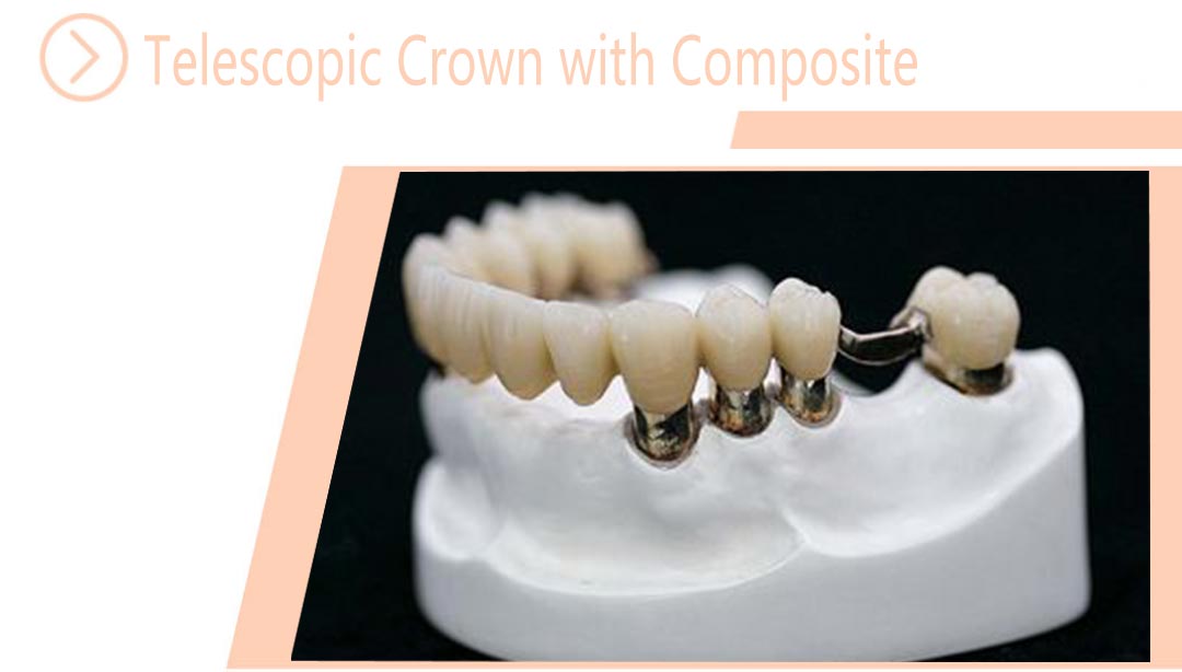 Telescopic Crown with Composite