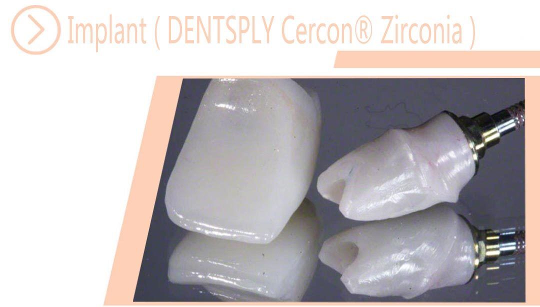 Implant ( DENTSPLY Cercon® Zirconia )