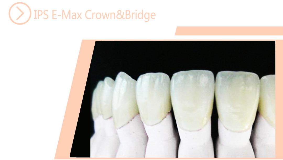 IPS E-Max Crown&Bridge