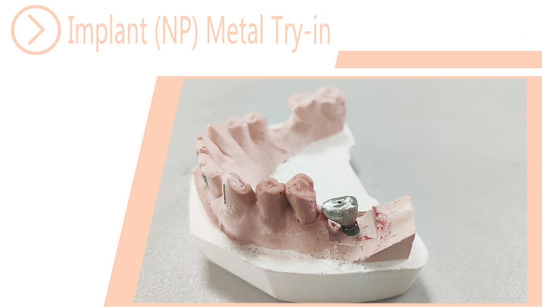 Implant (NP) Metal Try-in