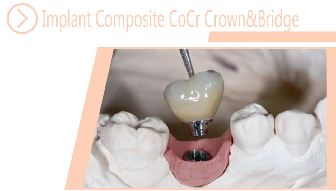 mplant Composite CoCr Crown&Bridge