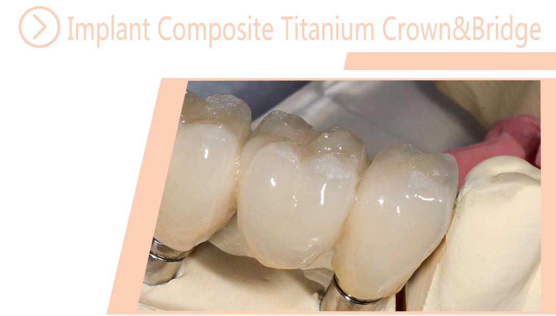 Implant Composite Titanium Crown&Bridge