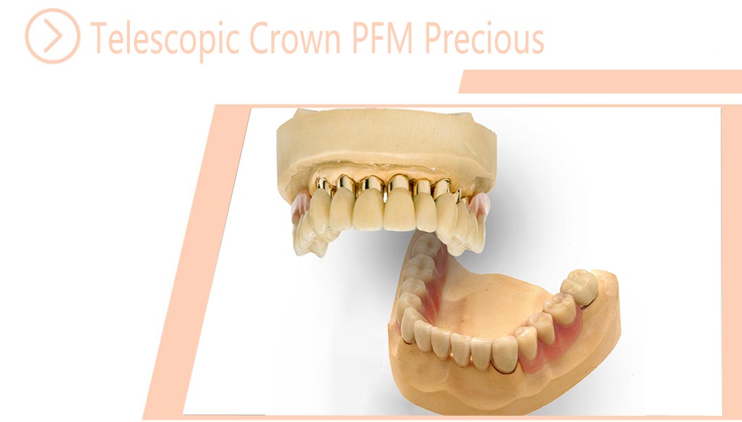 Telescopic Crown PFM Precious