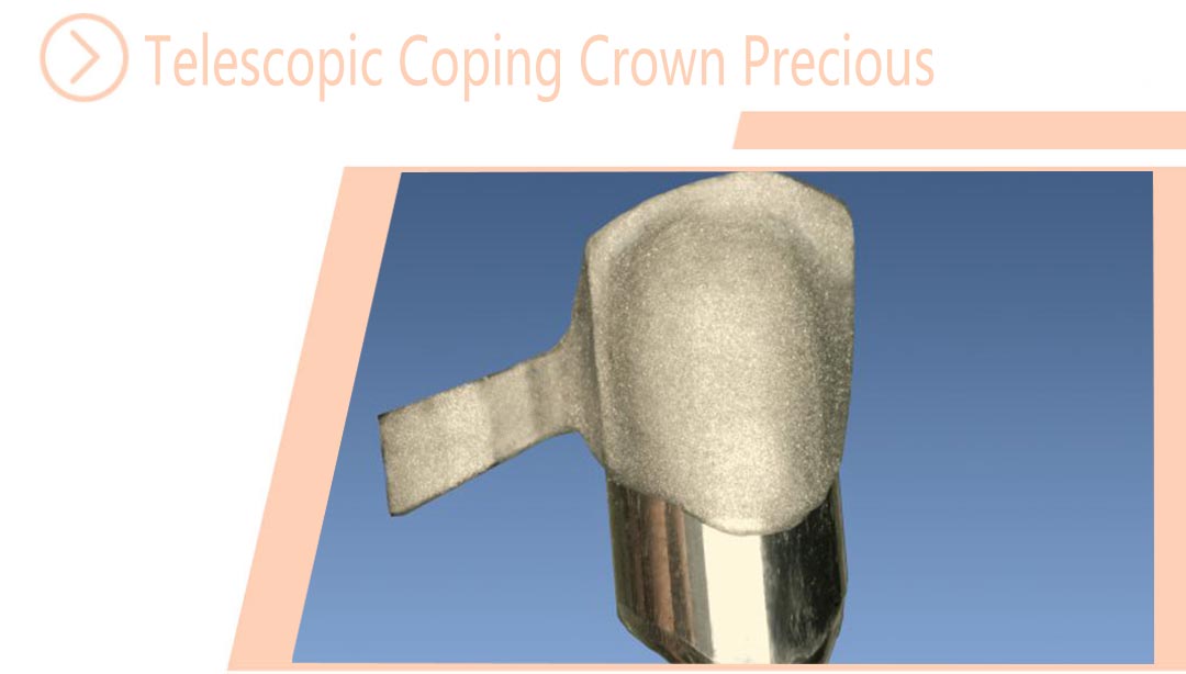 Telescopic Coping Crown Precious