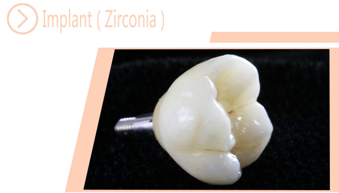 Implant ( Zirconia )