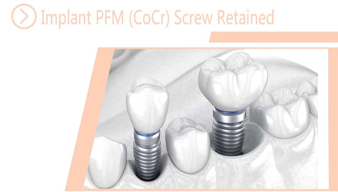 Implant PFM (CoCr) Screw Retained