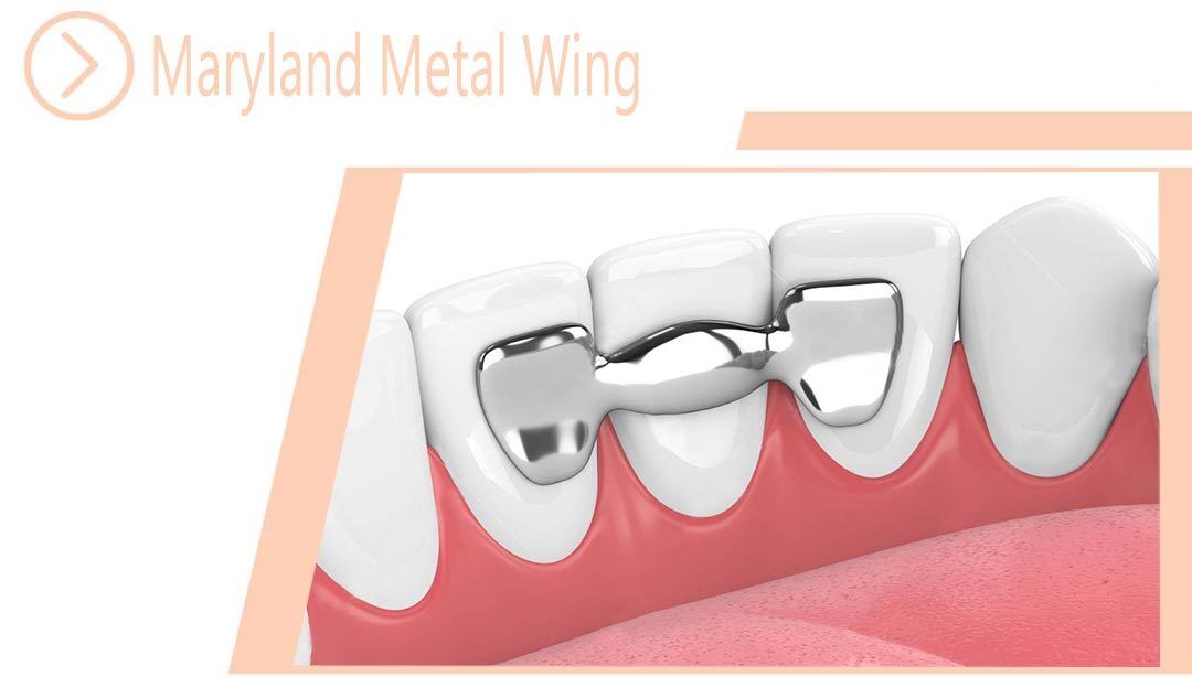 Maryland Metal Wing