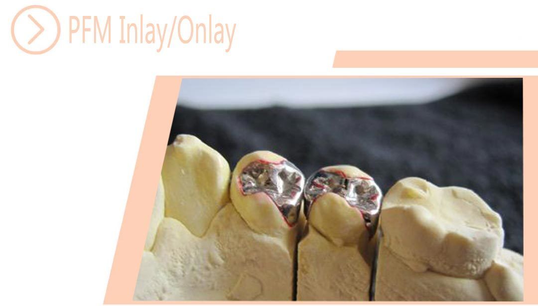 PFM Inlay/Onlay